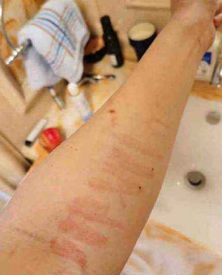  反击！张培萌妻子再晒受伤照反击 否认飞刀砍人